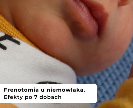 Frenotomia u niemowlaka. Efekty po 7 dobach