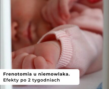Frenotomia u niemowlaka. Efekty po 2 tygodniach